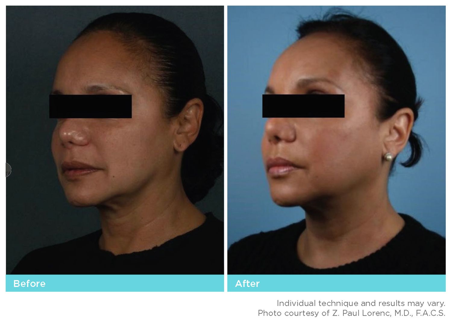 Thread Lift Before & After