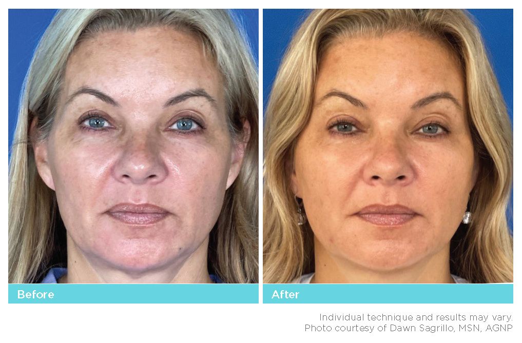 Thread Lift Before & After