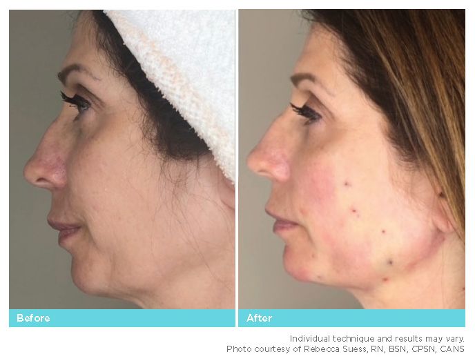 Thread Lift Before & After