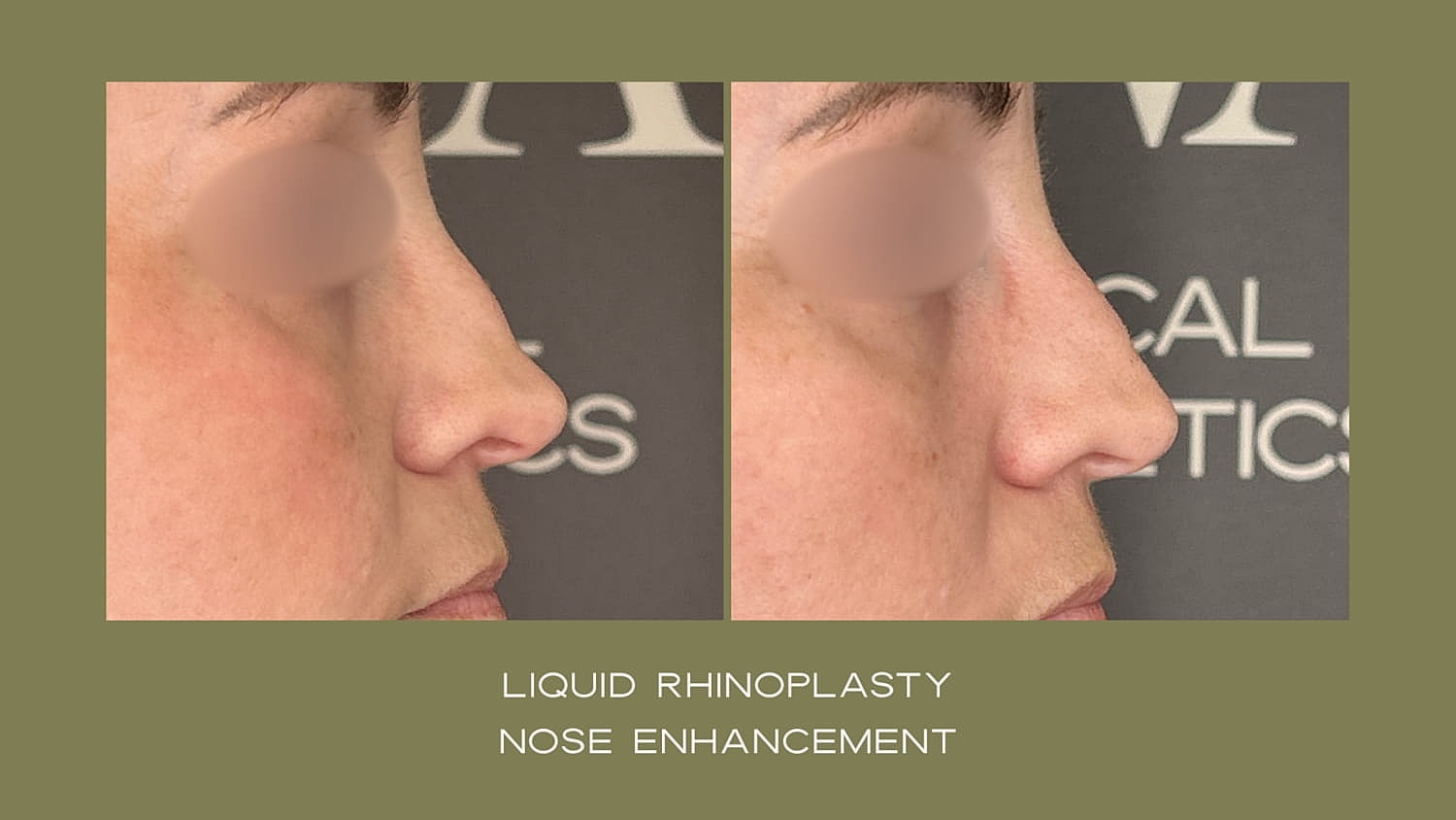 Before and after liquid rhinoplasty transformation.