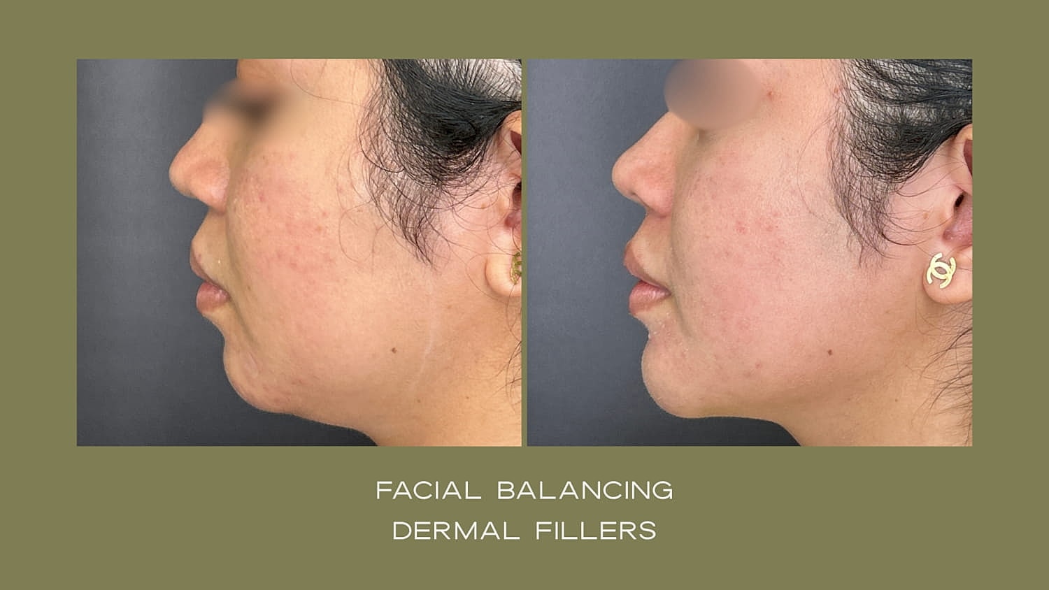 Before and after photo of facial fillers
