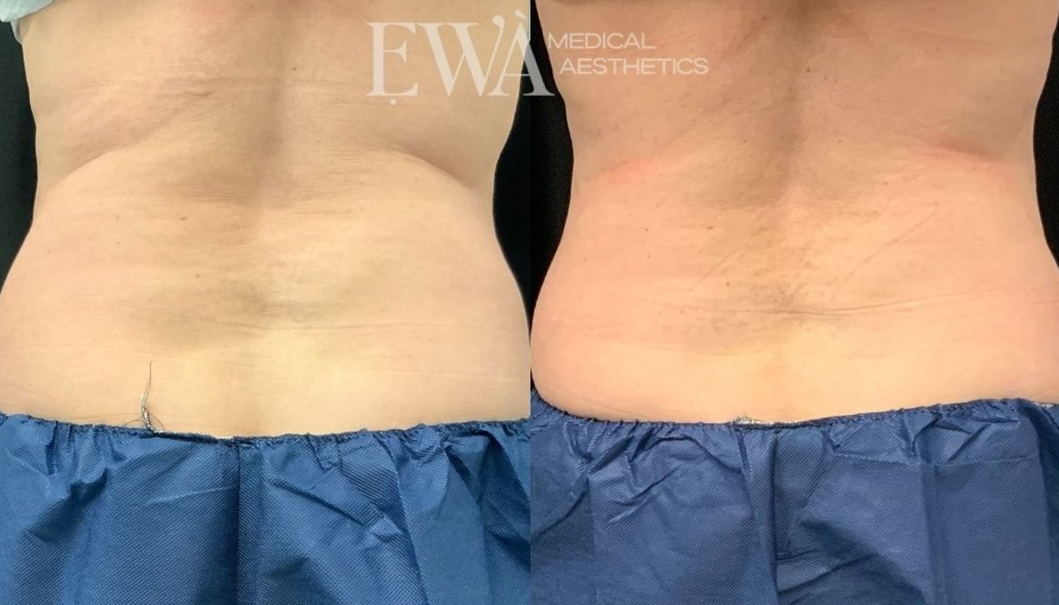 Coolsculpting Before & After