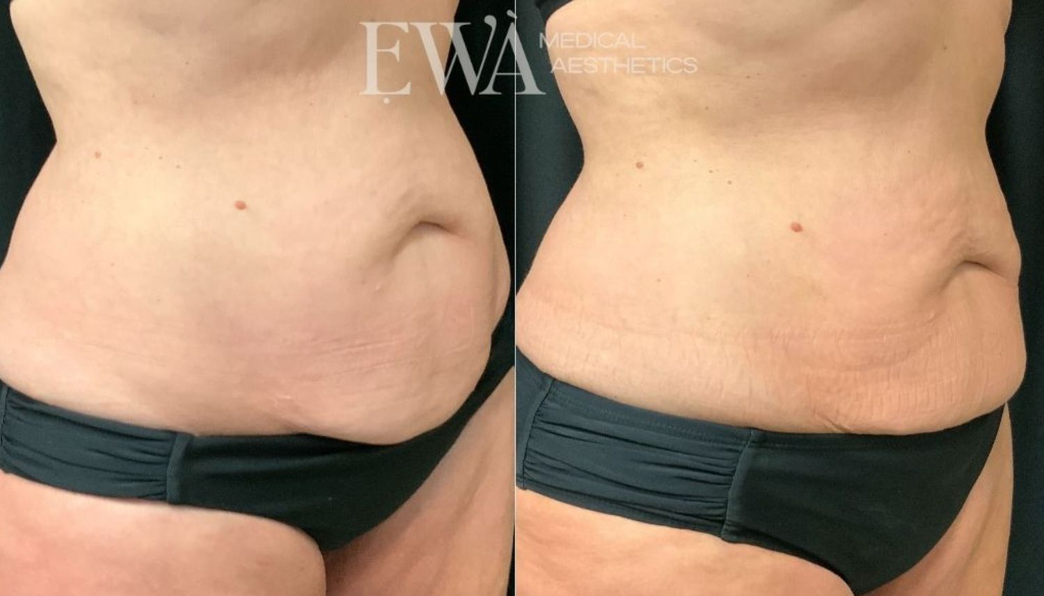 Coolsculpting Before & After