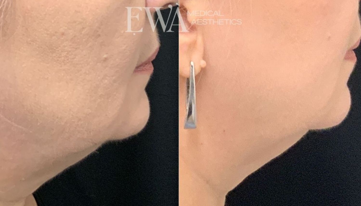 Coolsculpting Before & After