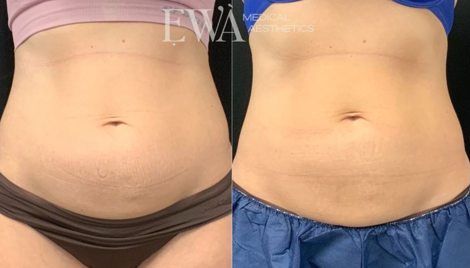 Coolsculpting Before & After