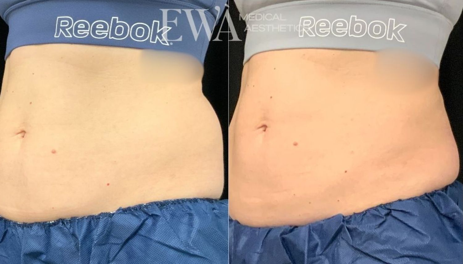 Coolsculpting Before & After
