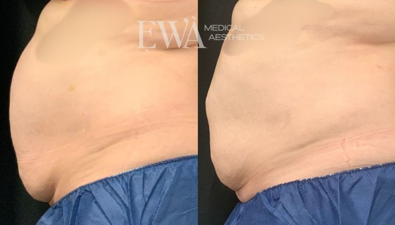 Coolsculpting Before & After