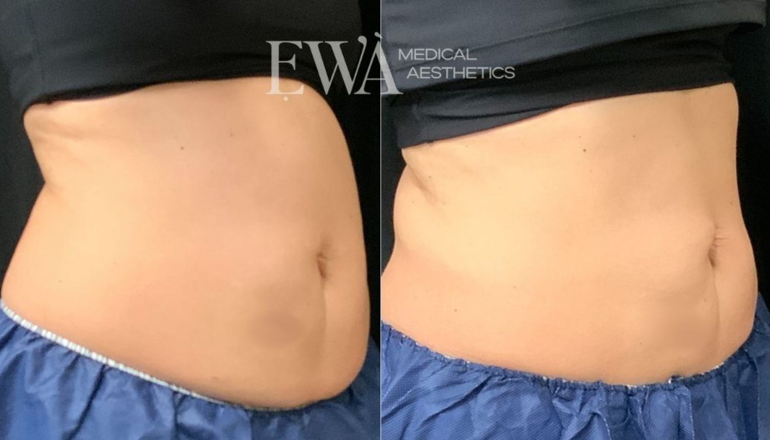 Coolsculpting Before & After