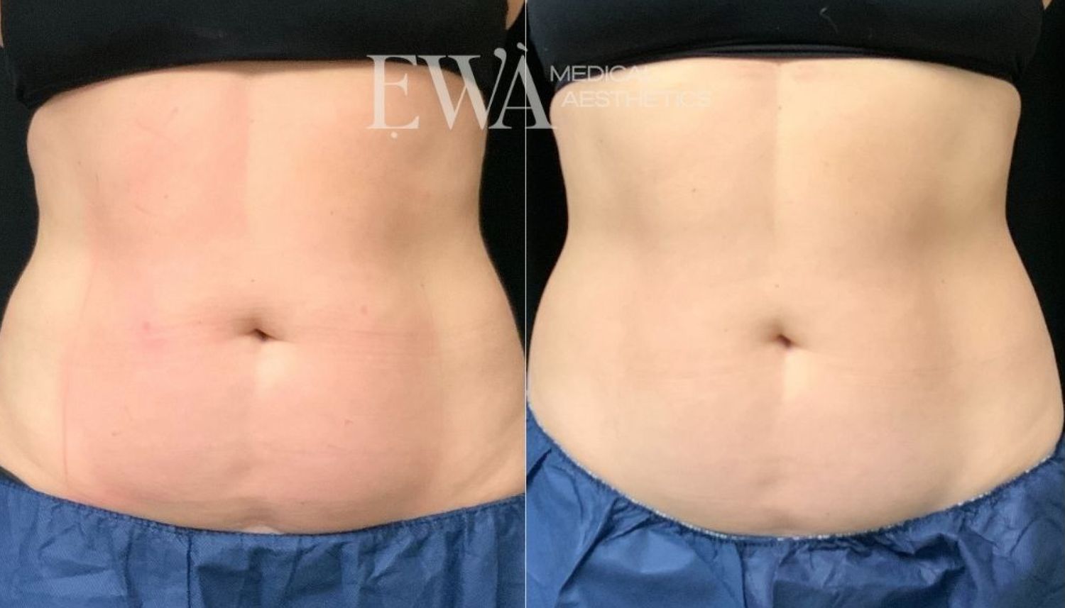Coolsculpting Before & After
