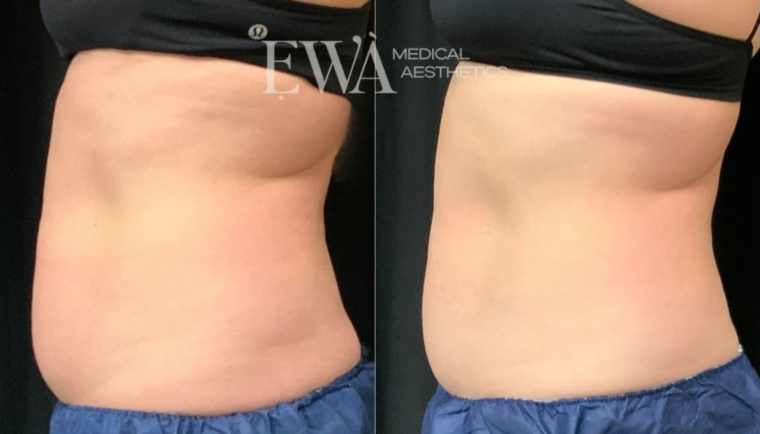 Coolsculpting Before & After