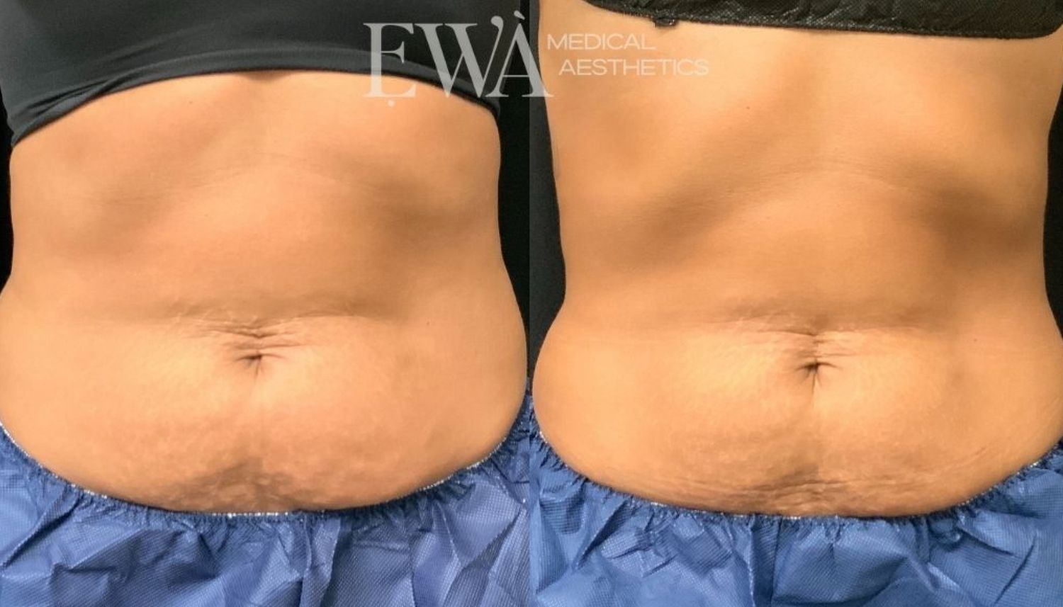 Coolsculpting Before & After