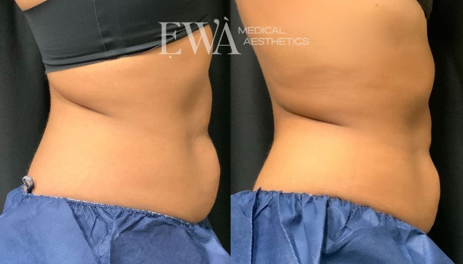 Coolsculpting Before & After