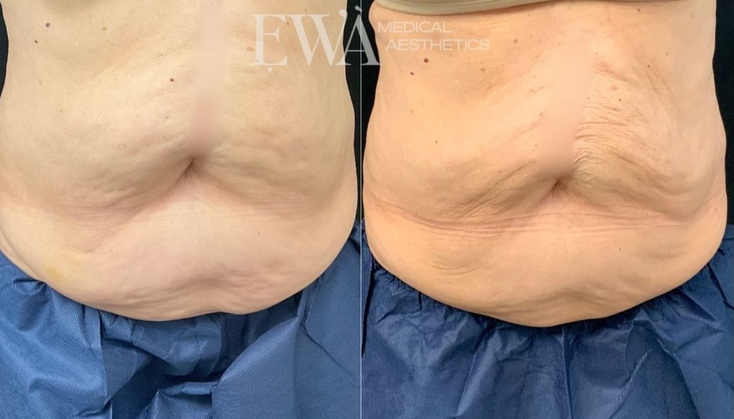 Coolsculpting Before & After