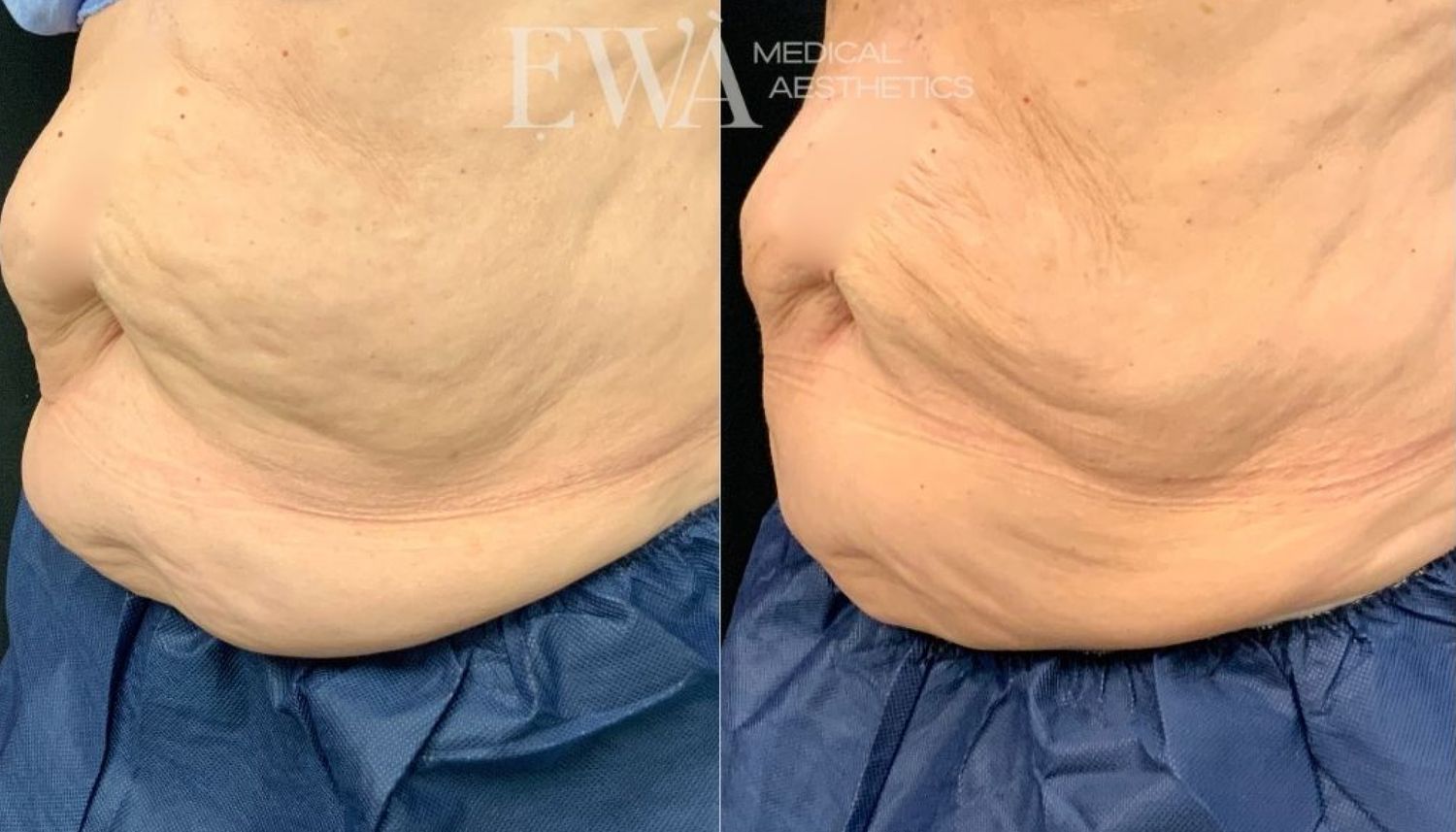 Coolsculpting Before & After