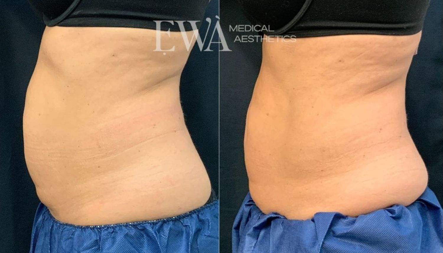 Coolsculpting Before & After