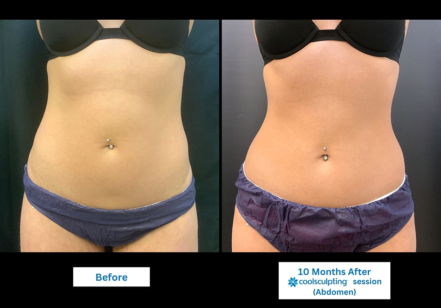 CoolSculpting Before & After