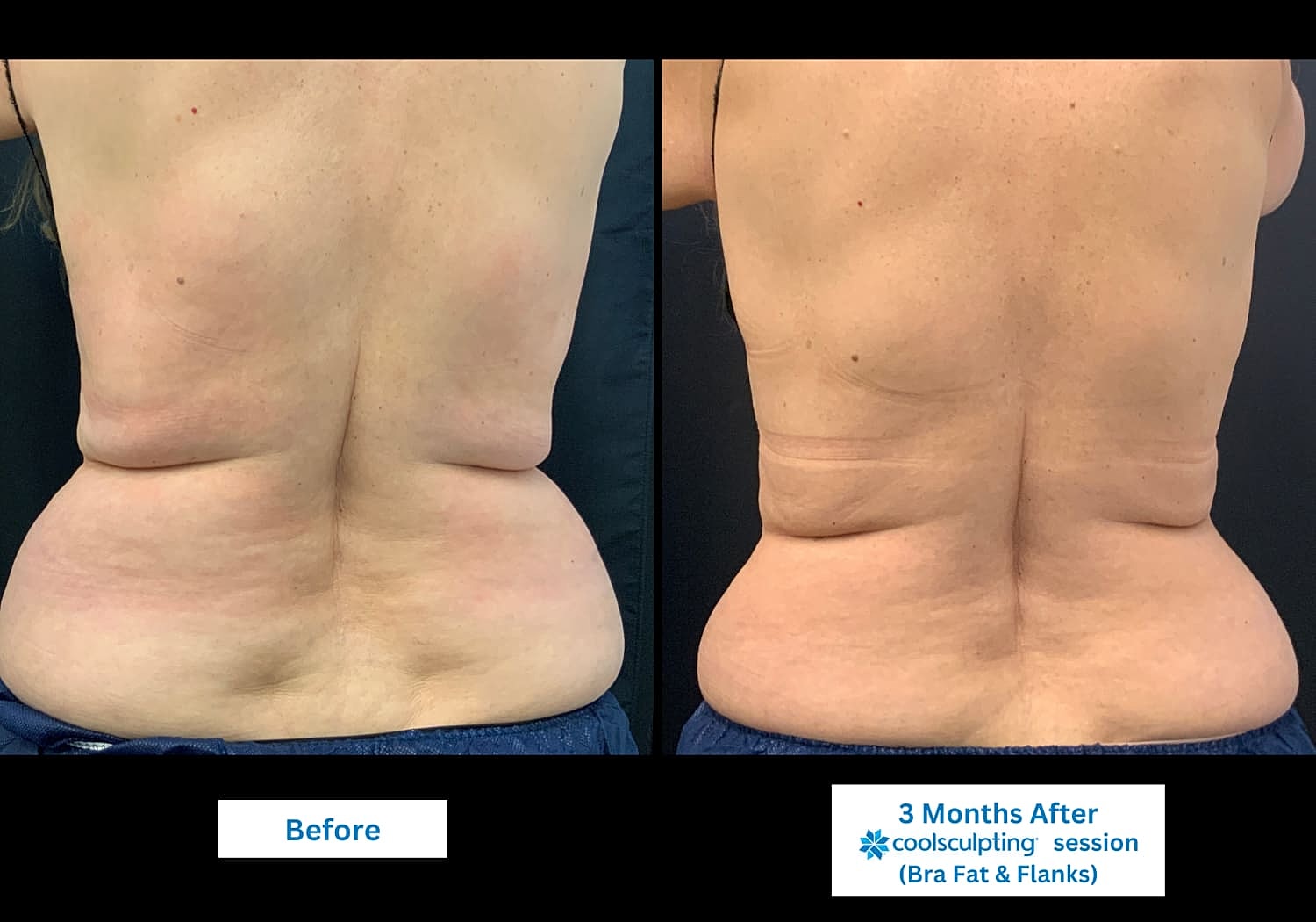 CoolSculpting Before & After