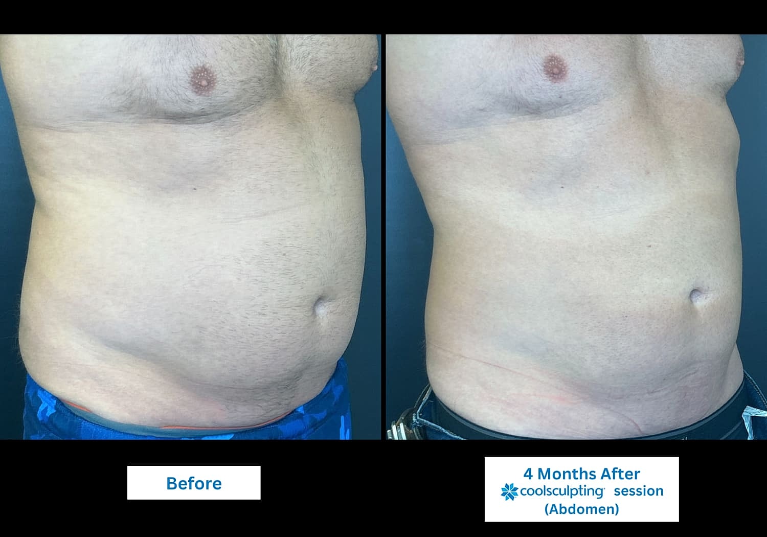 CoolSculpting Before & After