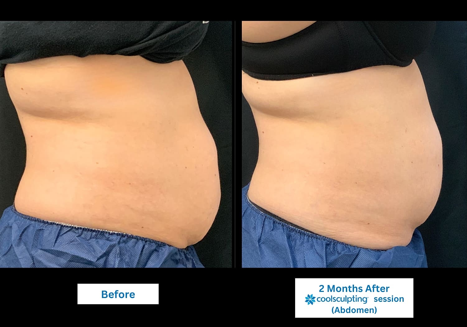 CoolSculpting Before & After