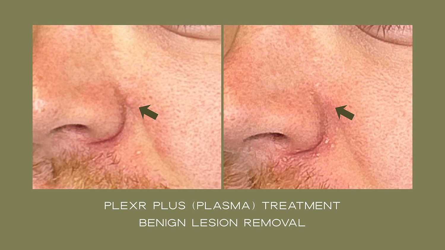 Plexr Before & After