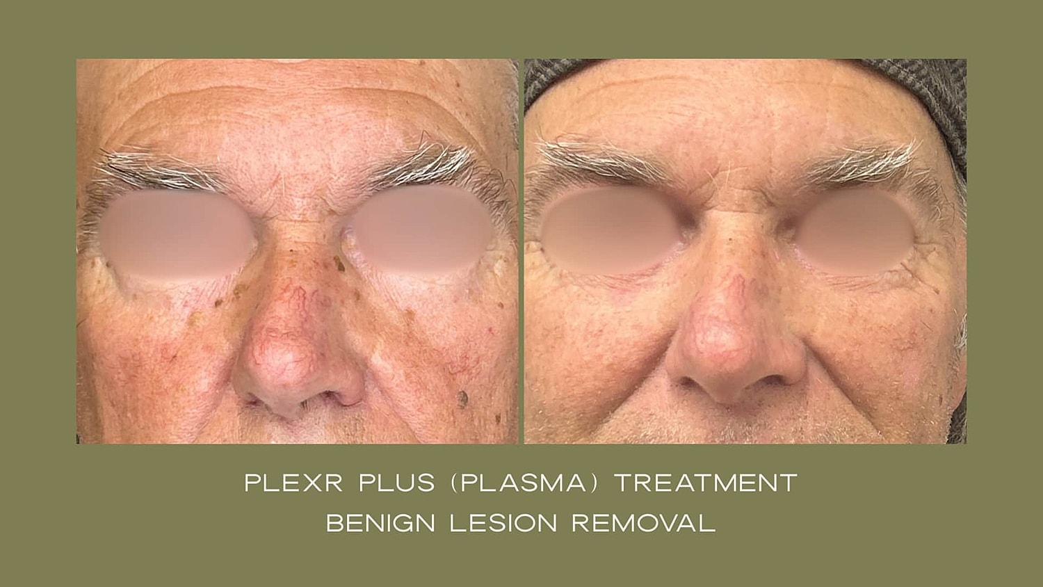 Plexr Before & After