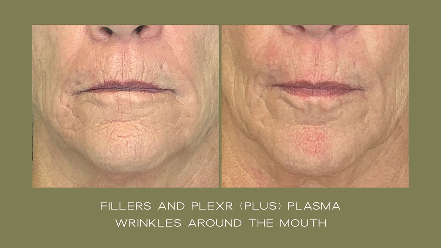 Plexr Before & After