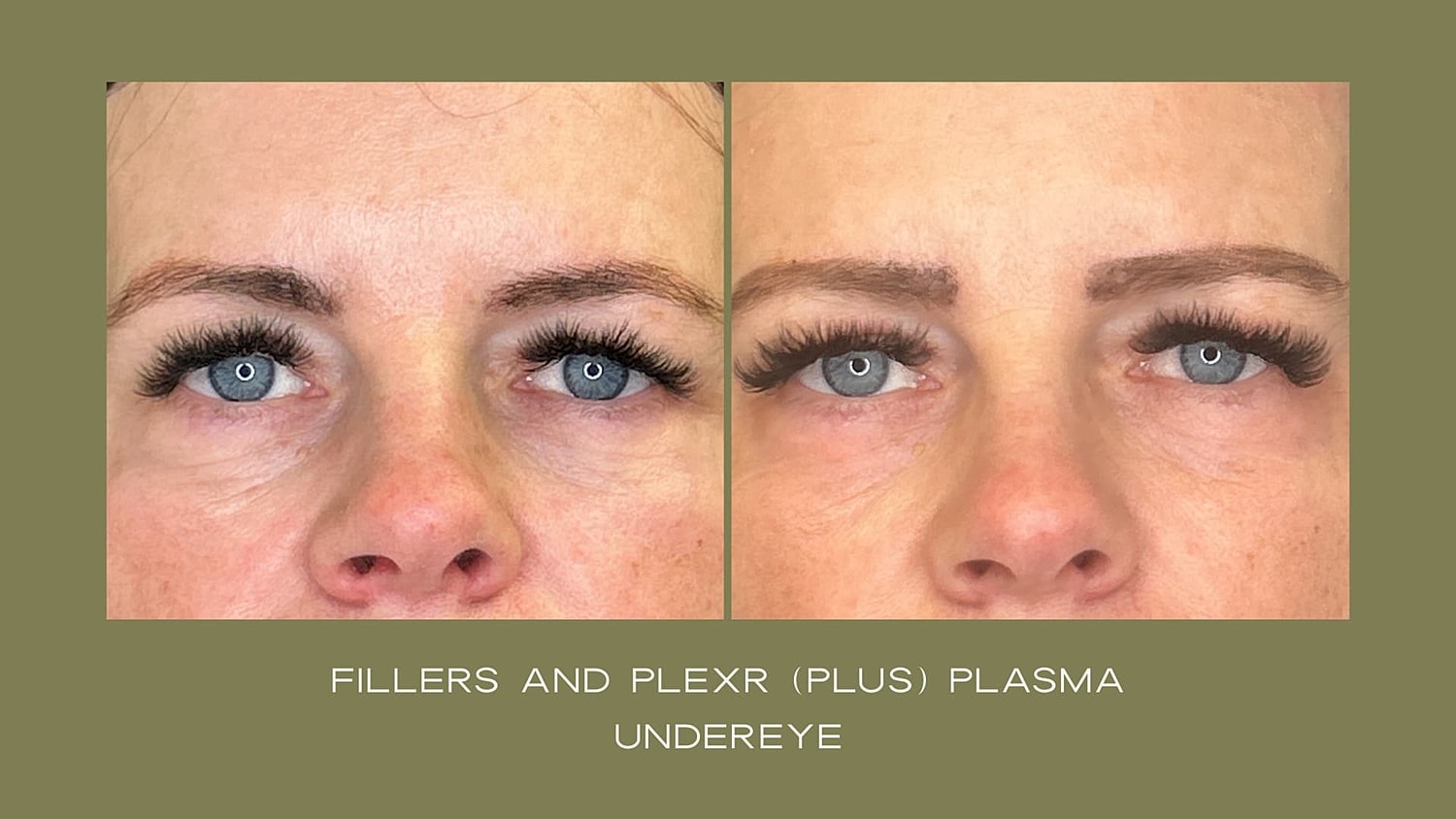 Plexr Before & After