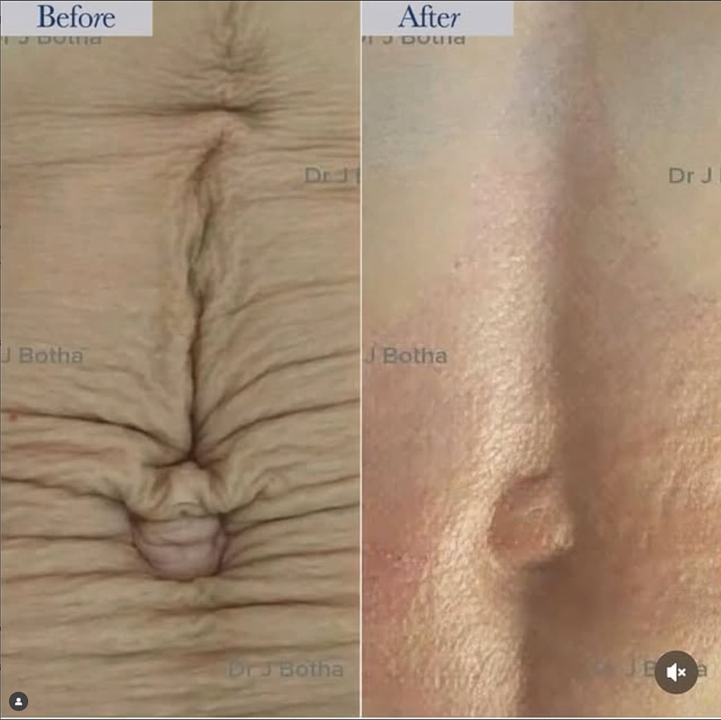 Plexr Before & After