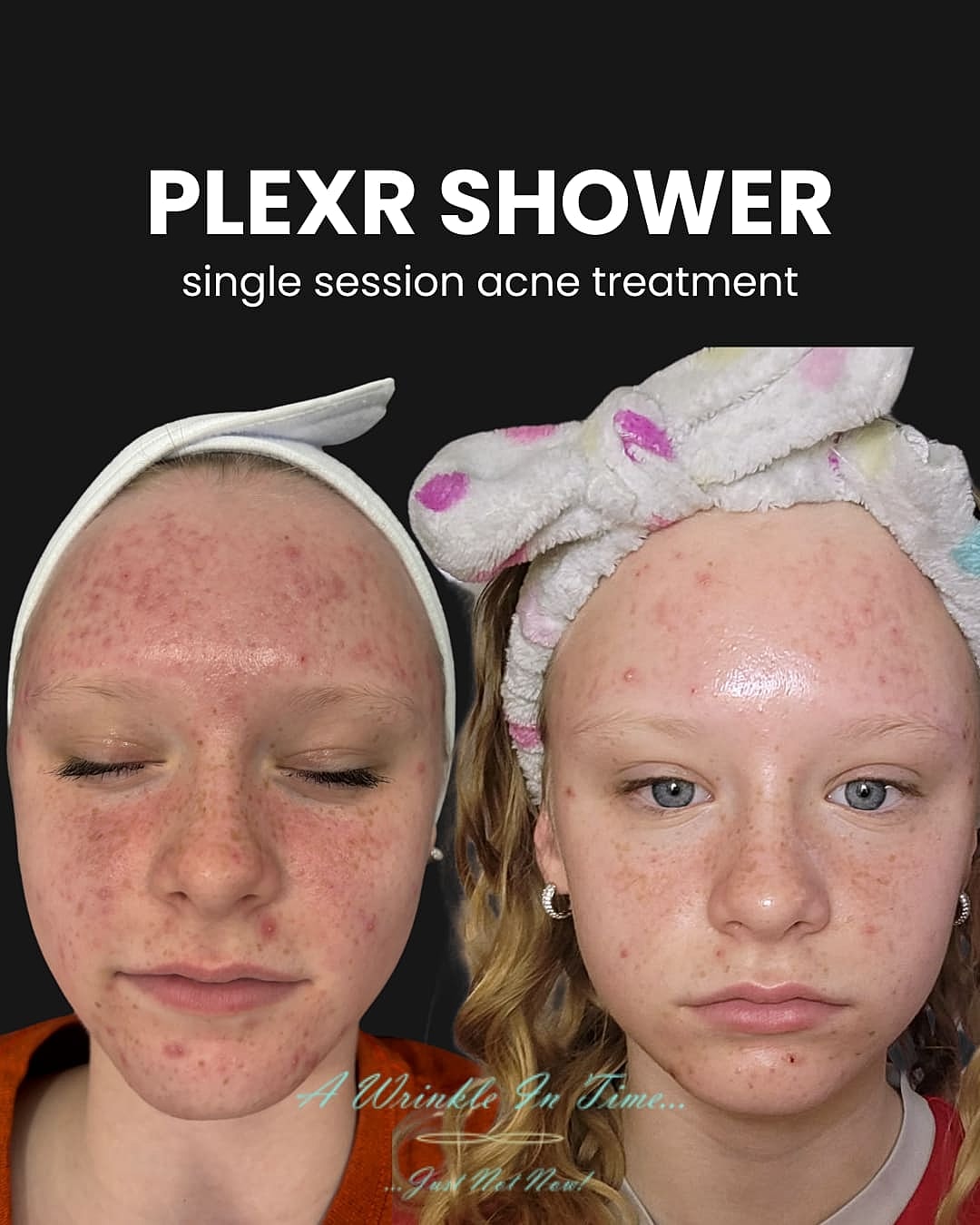 Plexr Before & After
