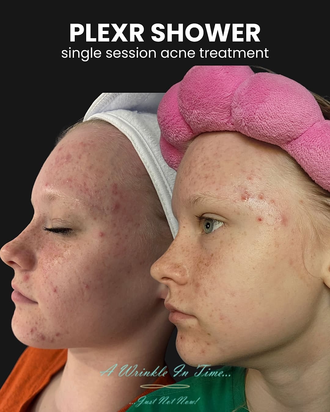 Plexr Before & After