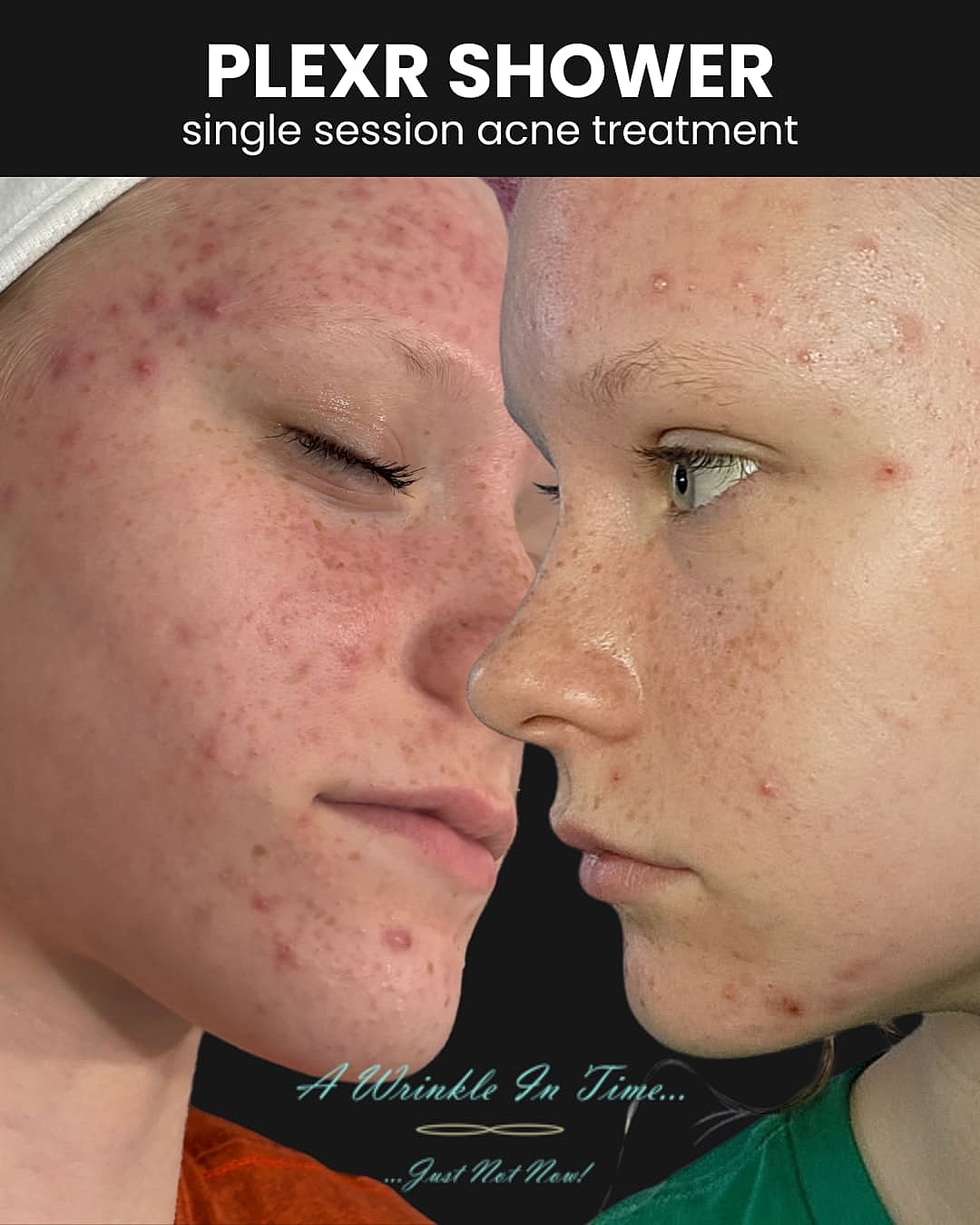 Plexr Before & After