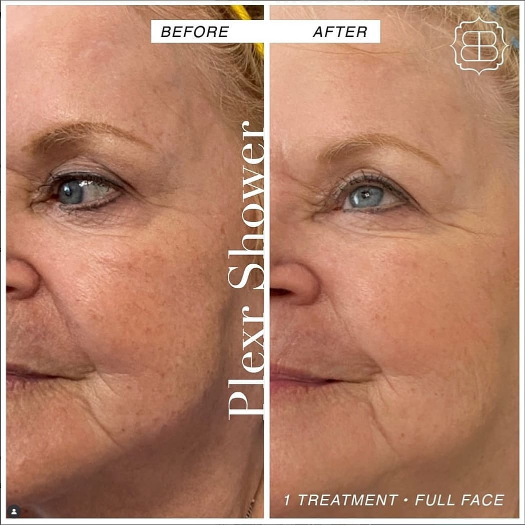 Plexr Before & After