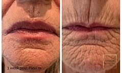 Plexr Before & After