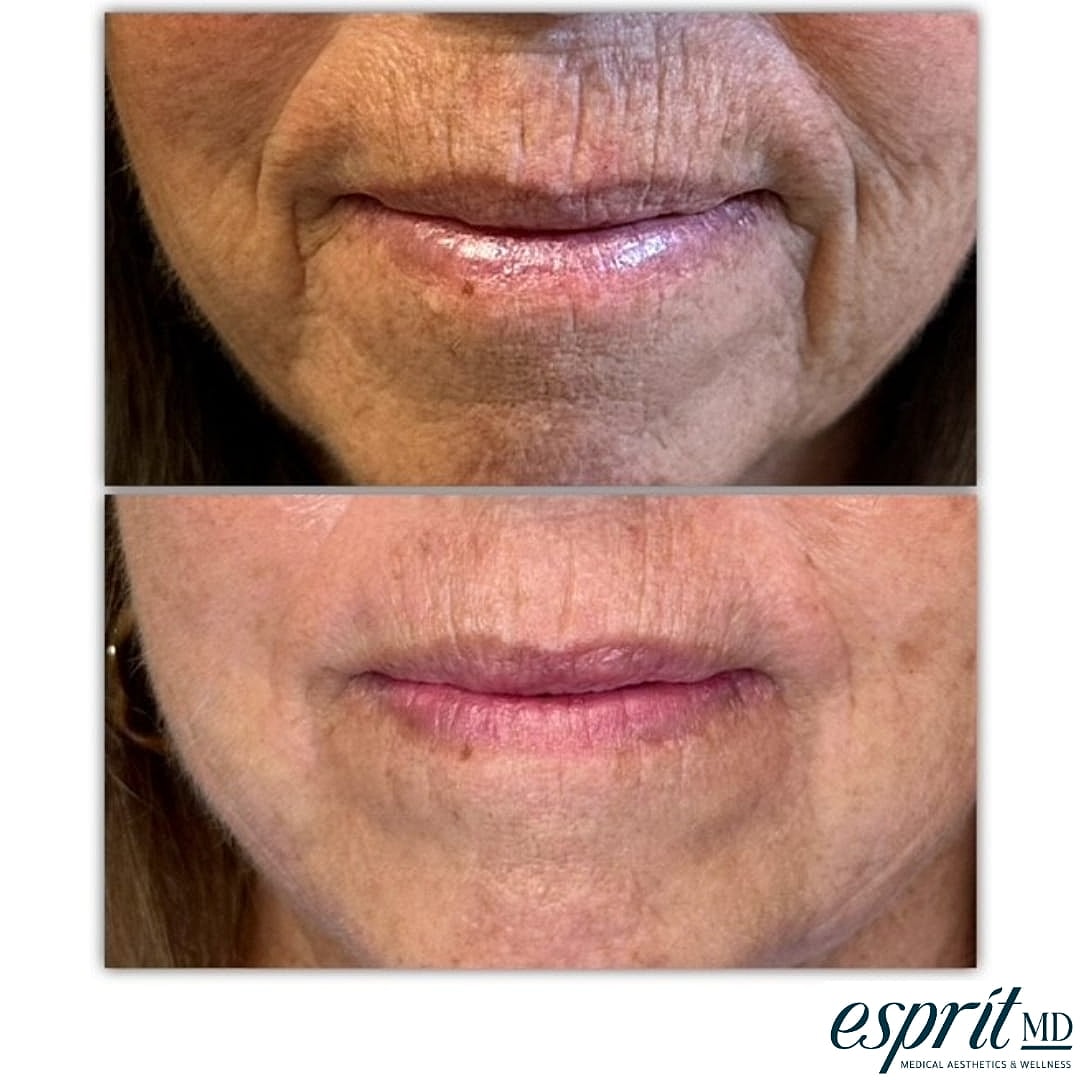 Plexr Before & After