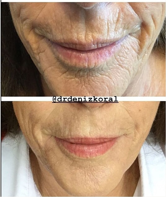 Plexr Before & After