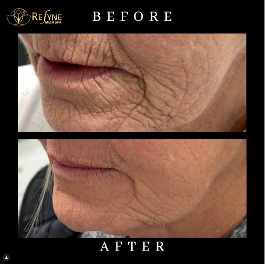 Plexr Before & After