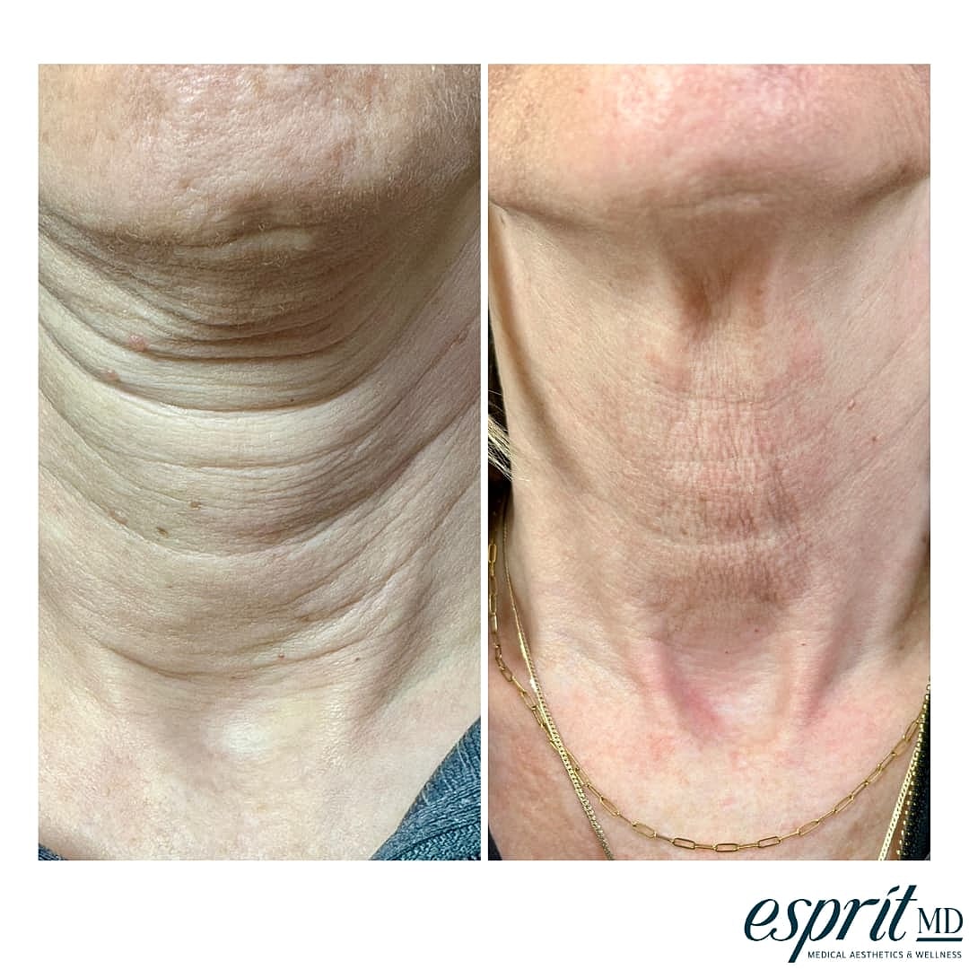 Plexr Before & After