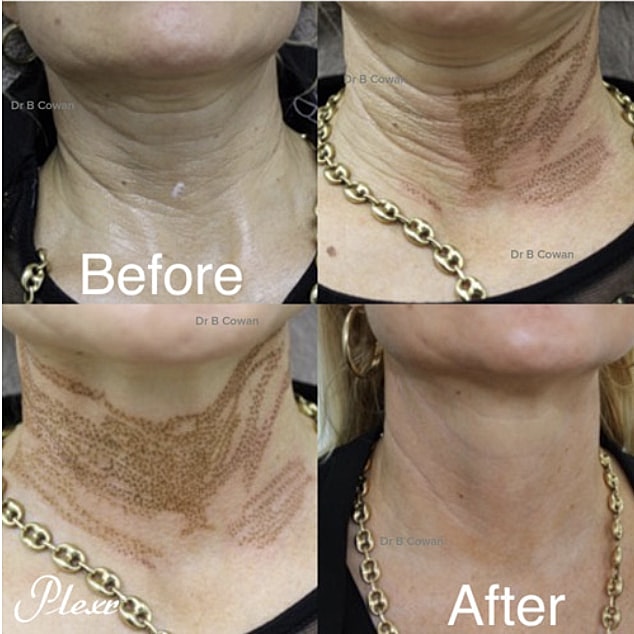 Plexr Before & After