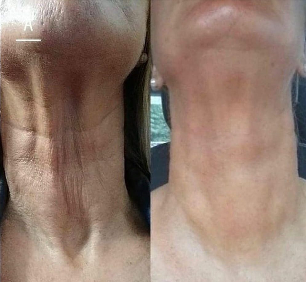 Plexr Before & After