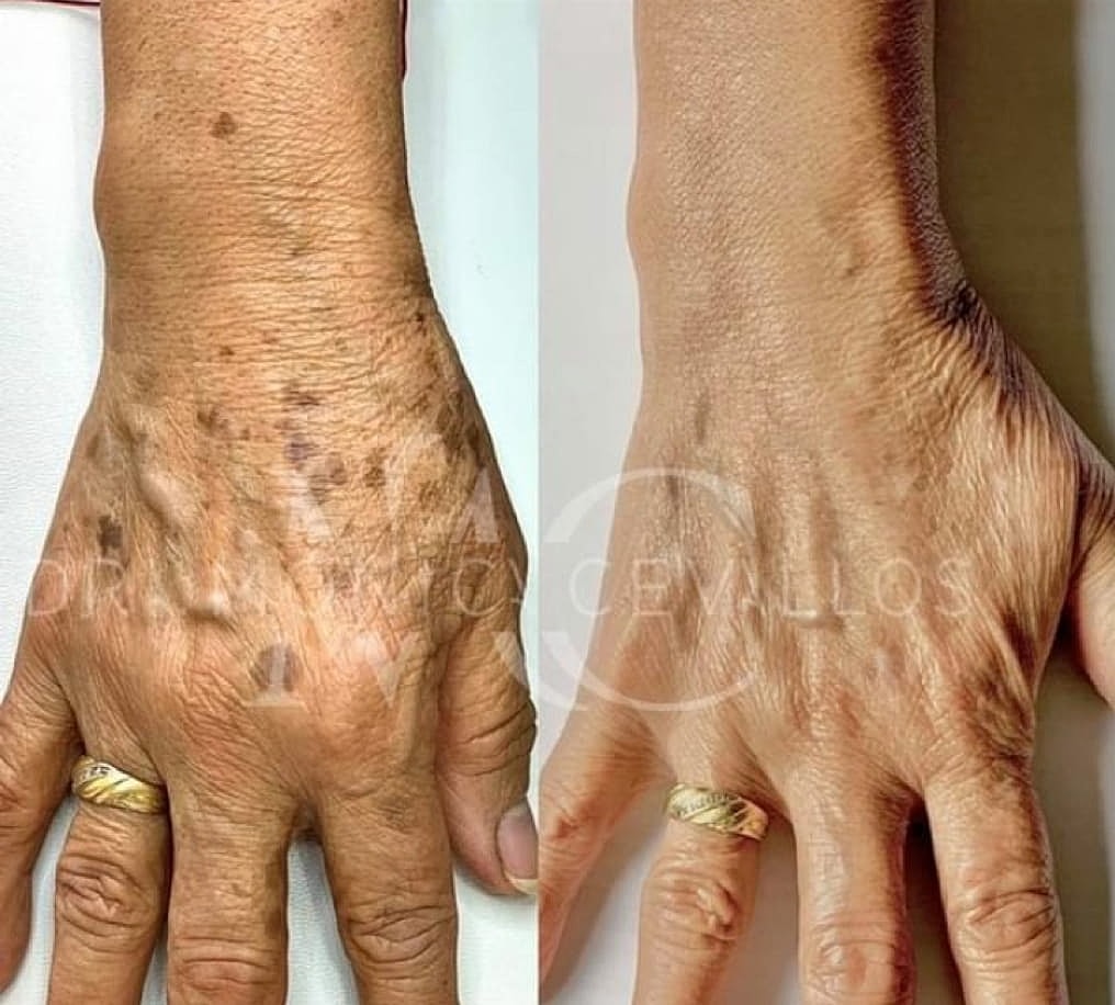 Plexr Before & After