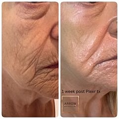 Plexr Before & After