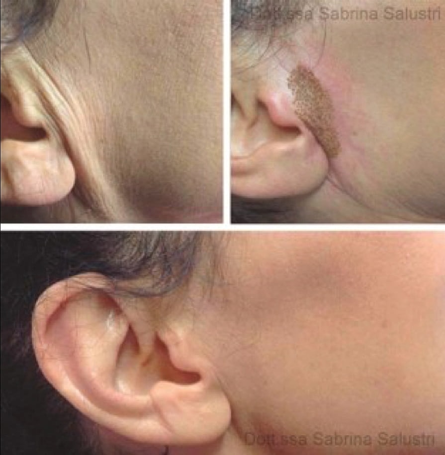 Plexr Before & After