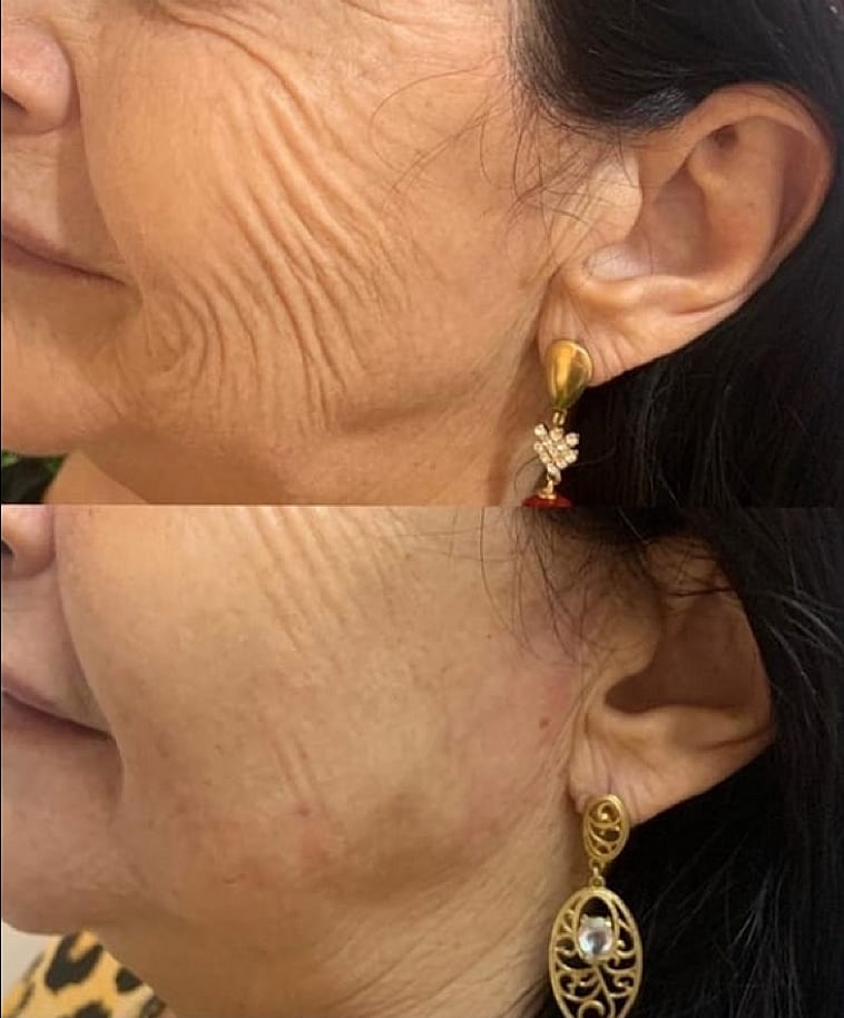 Plexr Before & After