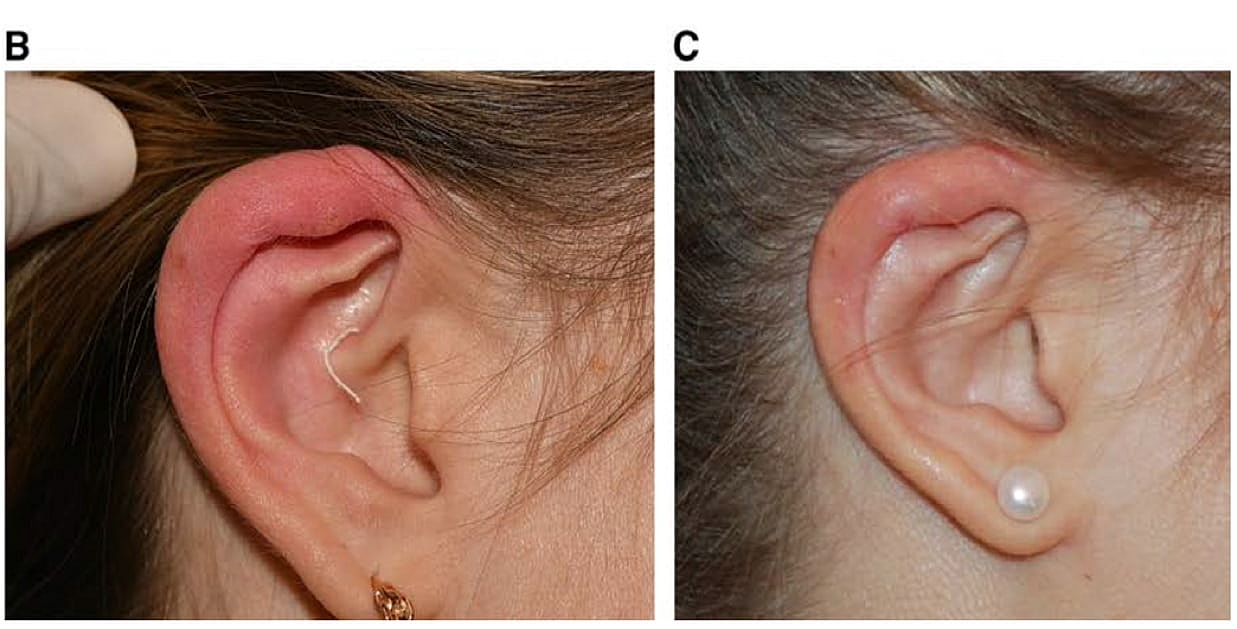 Plexr Before & After