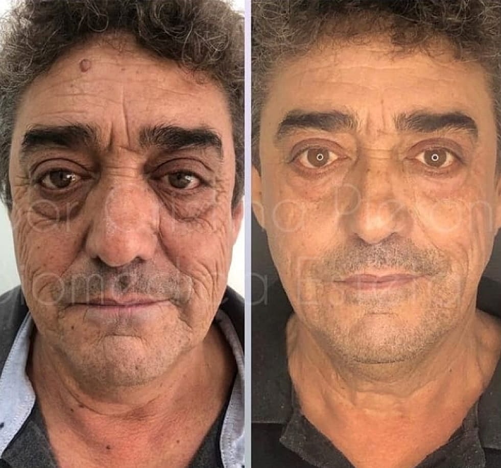 Plexr Before & After