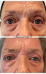 Plexr Before & After