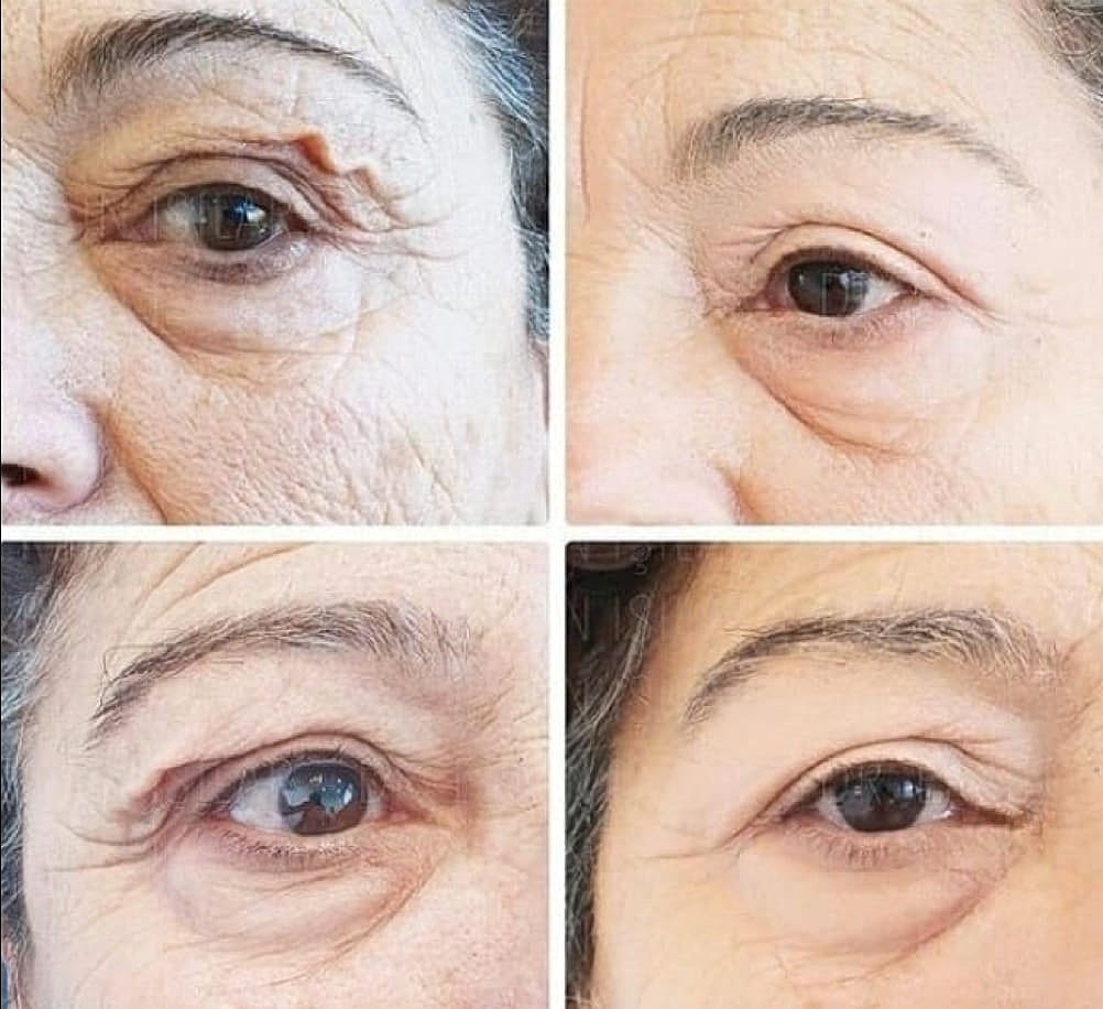 Plexr Before & After