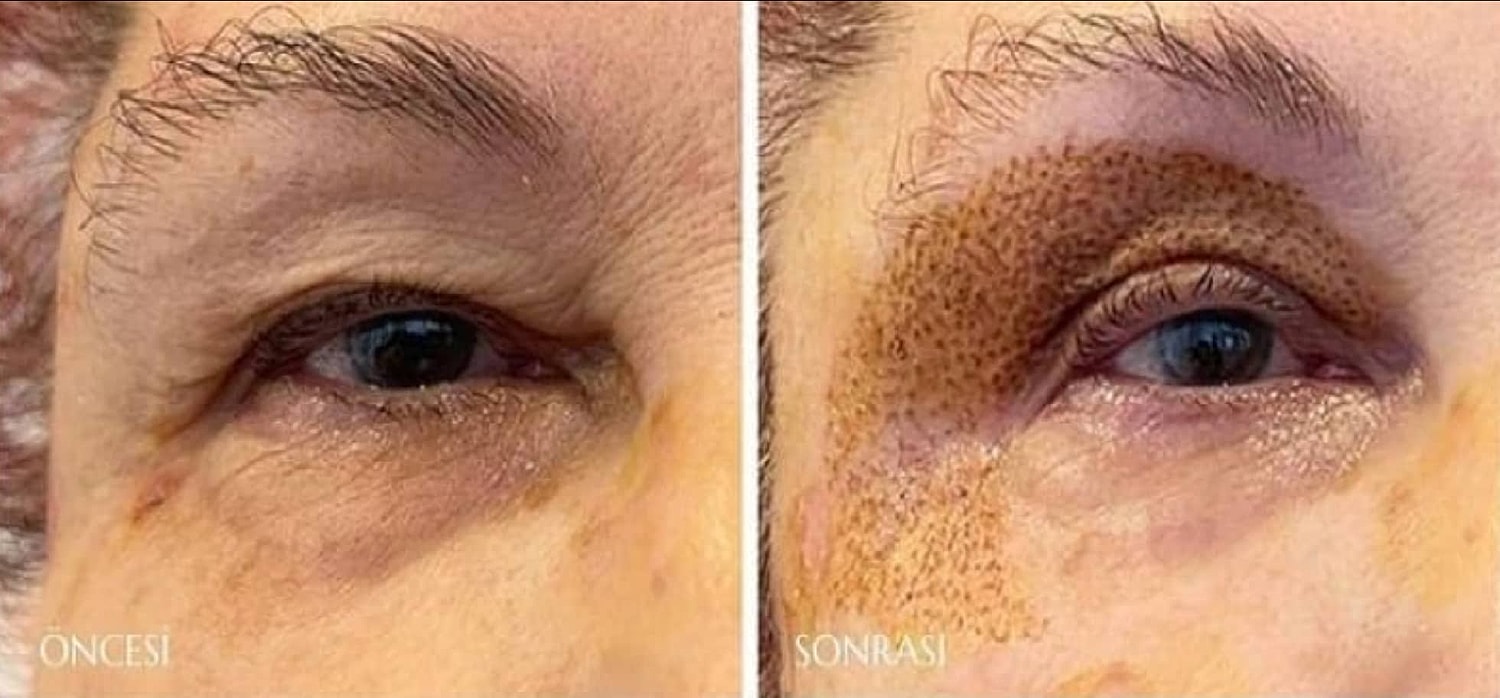 Plexr Before & After