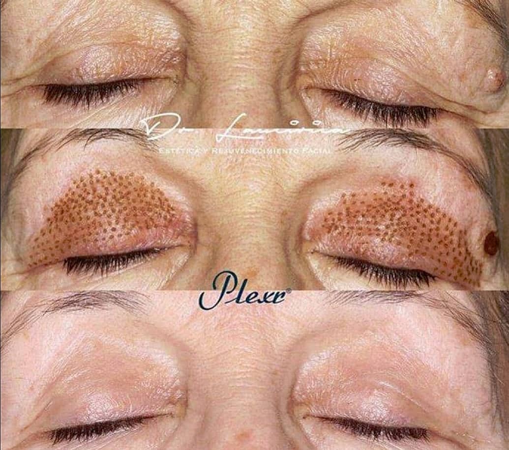 Plexr Before & After