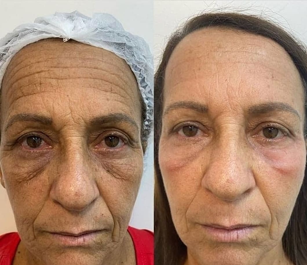 Plexr Before & After